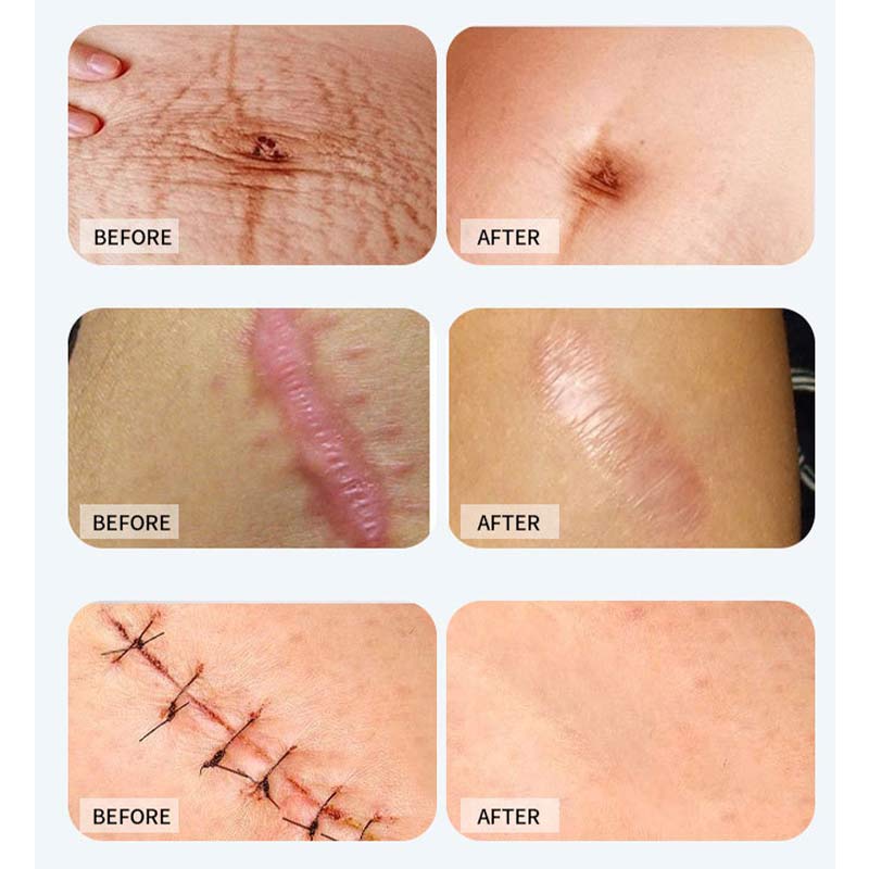 Skin-Color Anti-Bacterial And UV-Resistant Scar Reducing Patch